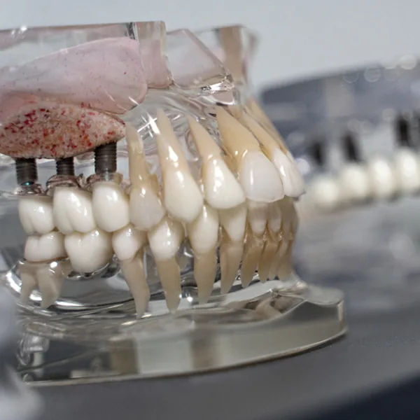 3D CT를 이용한 잇몸뼈 진단