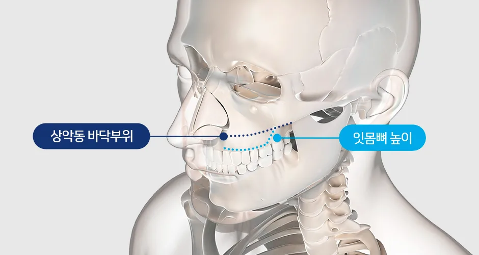 상악동 임플란트 안내 - 울산 남구 더조은플란트치과