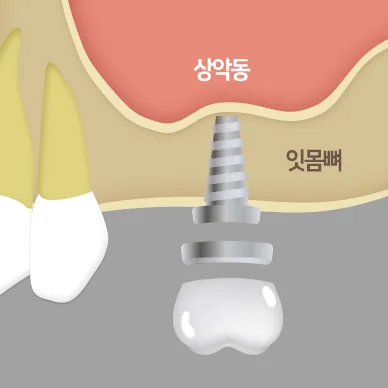 상악동 거상 후 임플란트 식립 개념