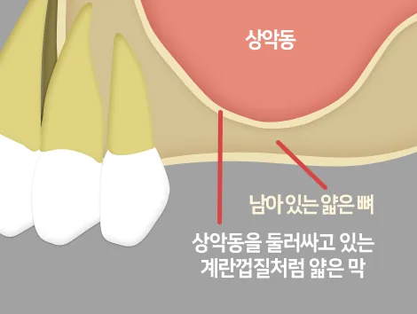 상악동 천공으로 인한 감염 위험