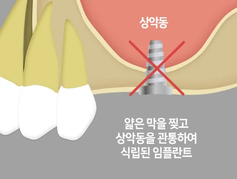 상악동 막 손상 위험